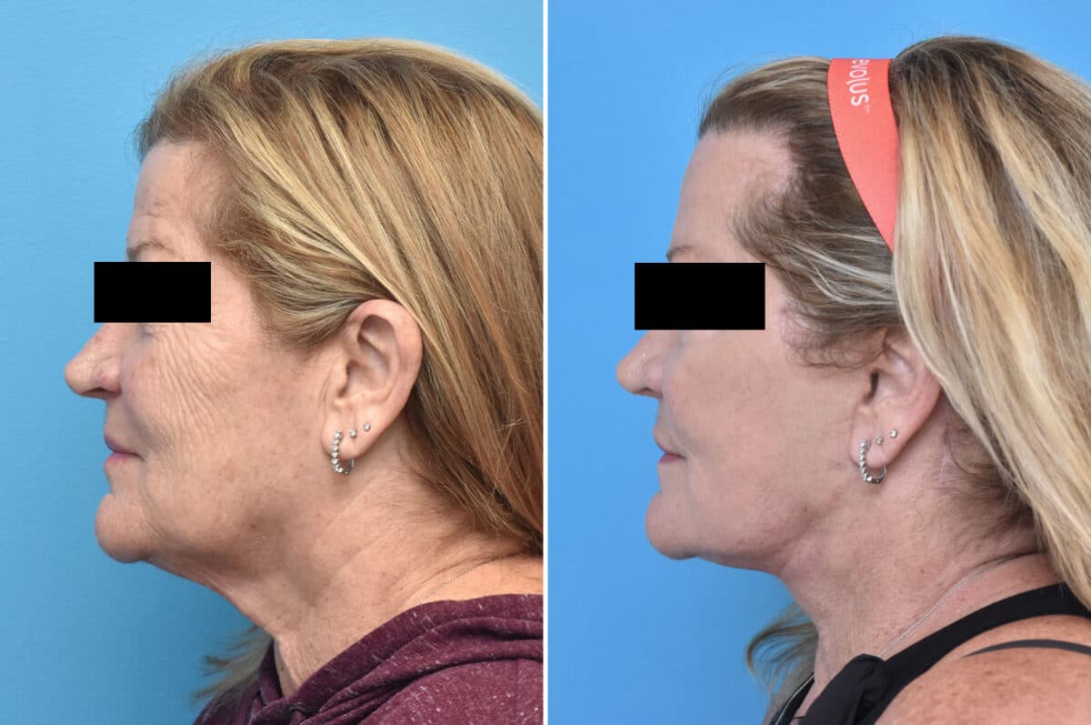 Facelift Before and After Photos in Philadelphia, PA, Patient 4354