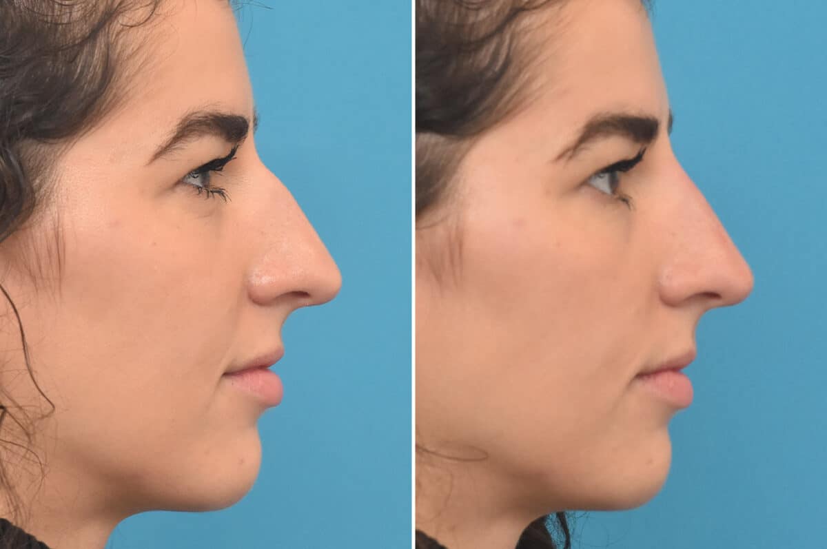 Liquid Rhinoplasty Before and After Photos in Philadelphia, PA, Patient 4382