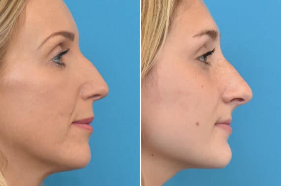 Liquid Rhinoplasty Before and After Photos in Philadelphia, PA, Patient 4383