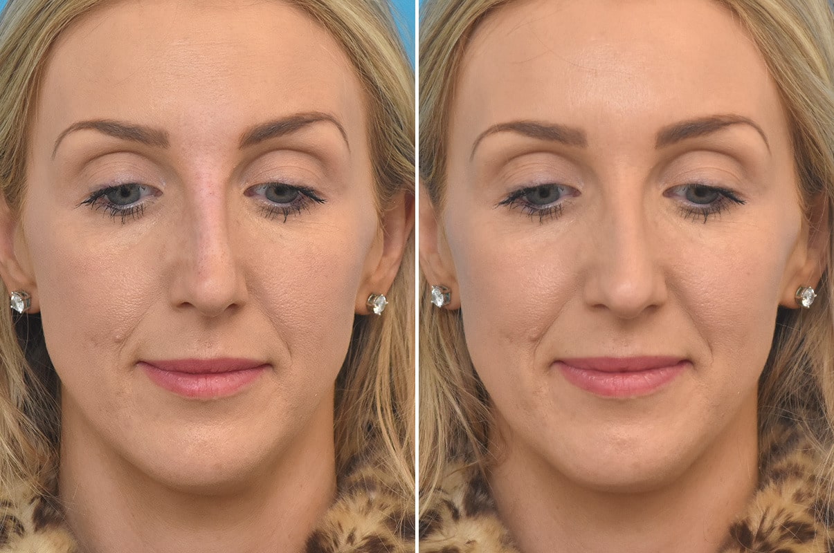 Liquid Rhinoplasty Photos Philadelphia, PA Patient 3461