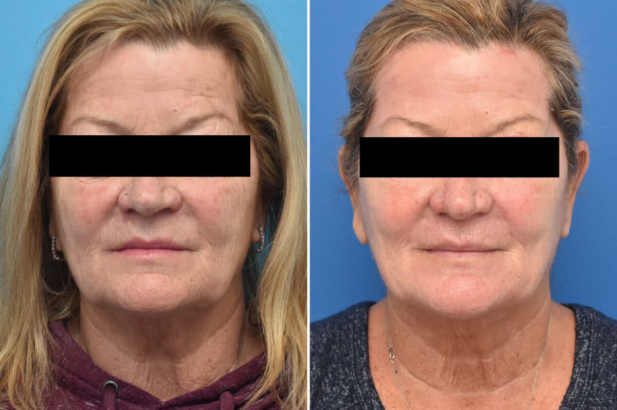 Chemical Peels Before and After Photos in Philadelphia, PA, Patient 4394