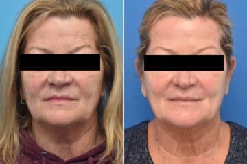 Chemical Peels Before and After Photos in Philadelphia, PA, Patient 4394