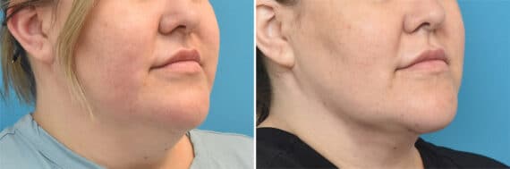 Neck Lift Before and After Photos in Philadelphia, PA, Patient 4399