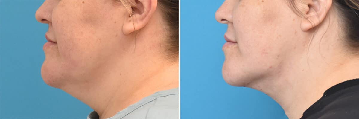 Neck Lift Before and After Photos in Philadelphia, PA, Patient 4399