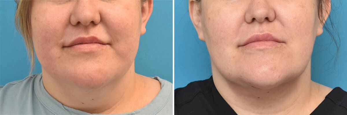 Neck Lift Before and After Photos in Philadelphia, PA, Patient 4399