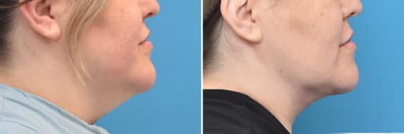 Neck Lift Before and After Photos in Philadelphia, PA, Patient 4399