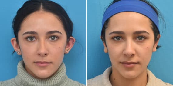 Otoplasty Before and After Photos in Philadelphia, PA, Patient 4412