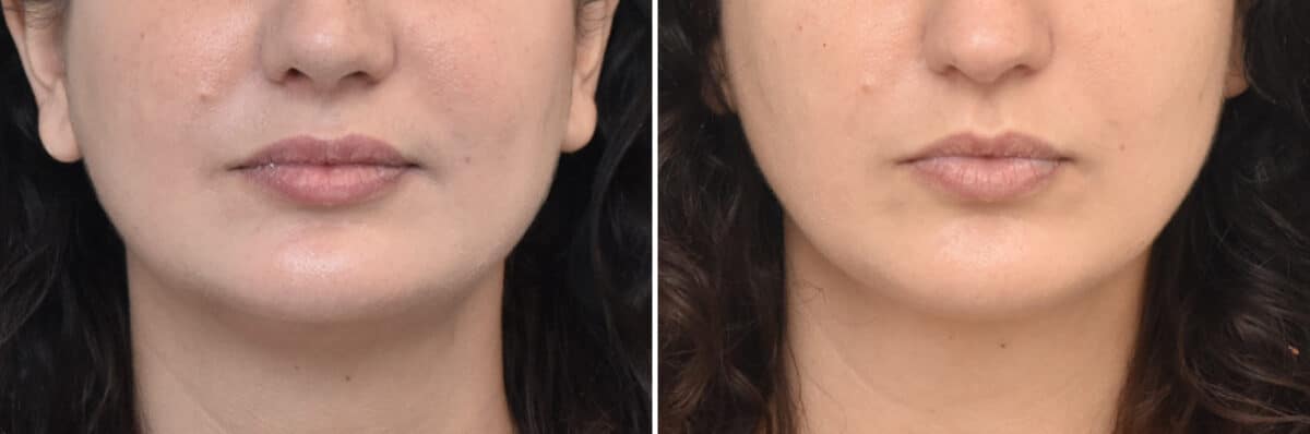 Facial Slimming Before and After Photos in Philadelphia, PA, Patient 4442