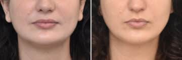 Facial Slimming Before and After Photos in Philadelphia, PA, Patient 4442