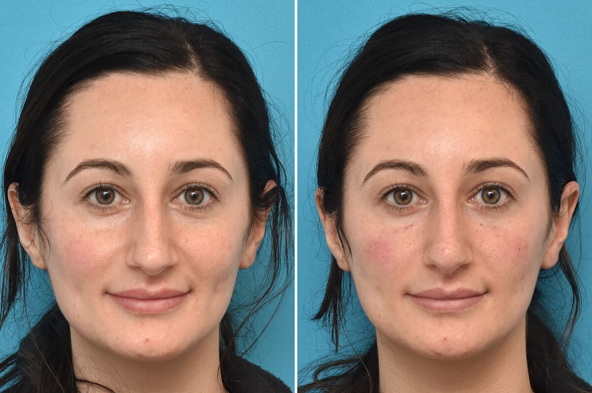 Injectable Fillers Before and After Photos in Philadelphia, PA, Patient 4479