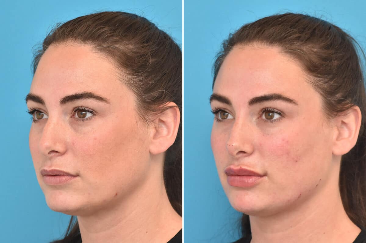 Injectable Fillers Before and After Photos in Philadelphia, PA, Patient 4480