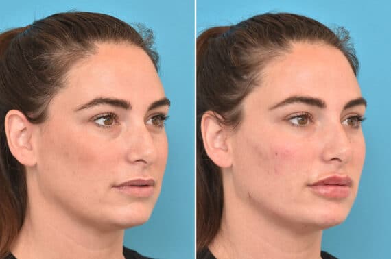 Injectable Fillers Before and After Photos in Philadelphia, PA, Patient 4480