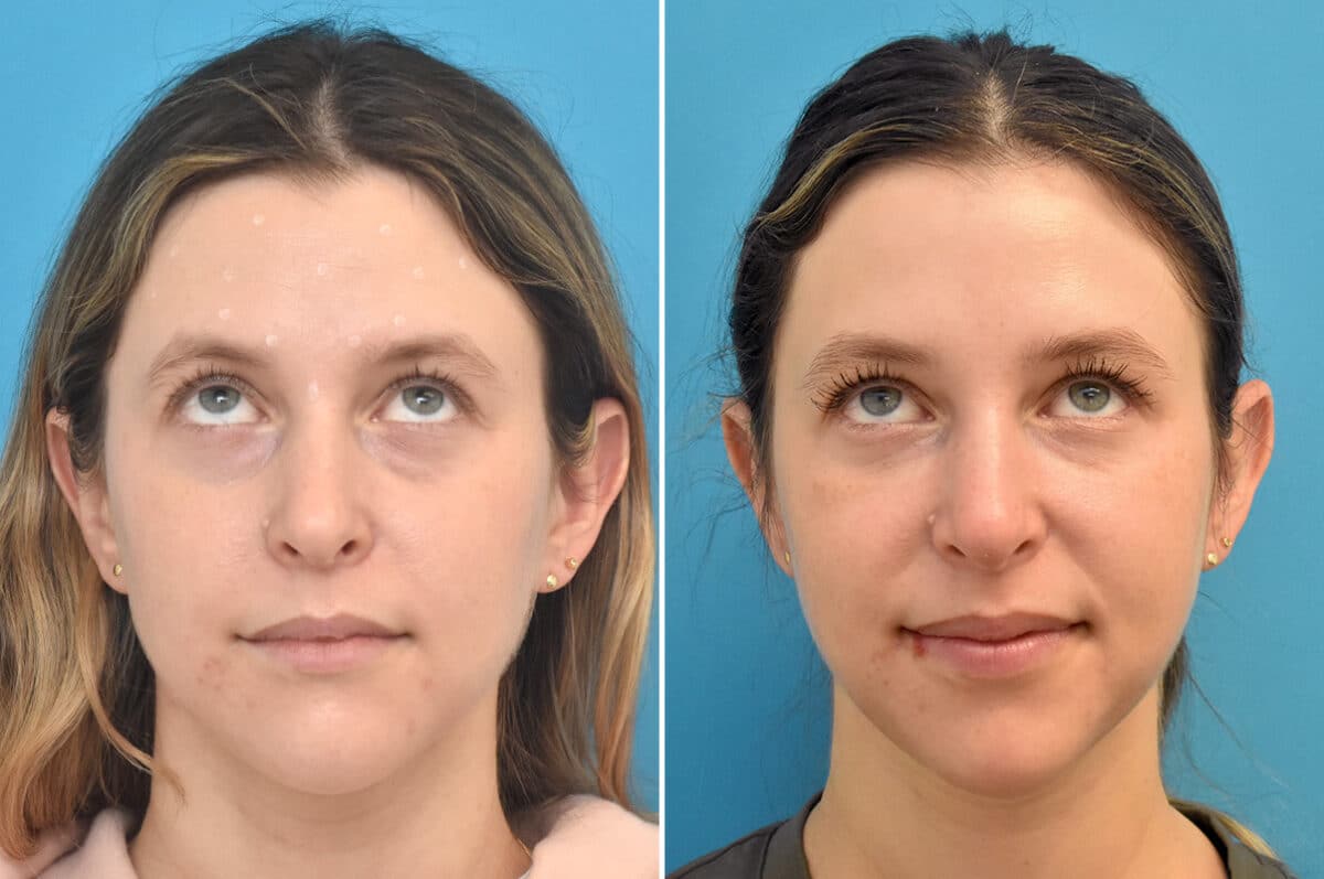 Injectable Fillers Before and After Photos in Philadelphia, PA, Patient 4481