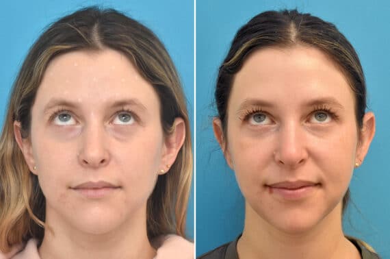 Injectable Fillers Before and After Photos in Philadelphia, PA, Patient 4481