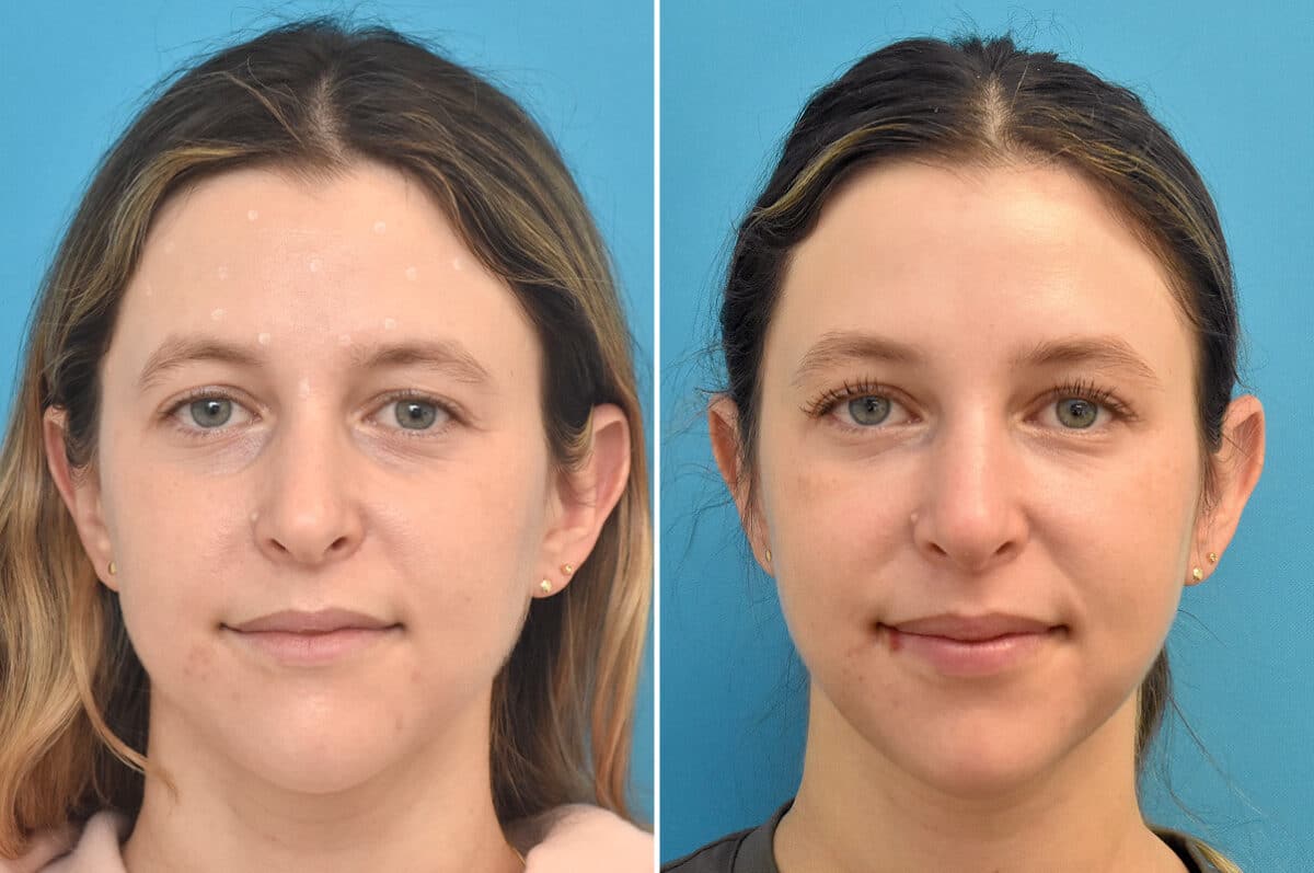 Injectable Fillers Before and After Photos in Philadelphia, PA, Patient 4481