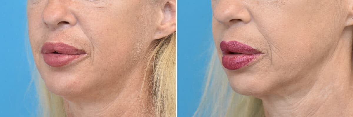 Injectable Fillers Before and After Photos in Philadelphia, PA, Patient 4482