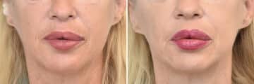 Injectable Fillers Before and After Photos in Philadelphia, PA, Patient 4482