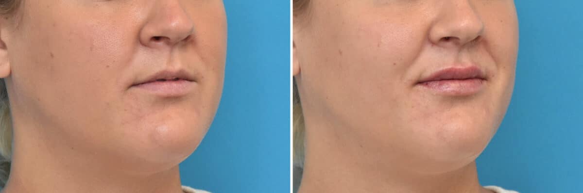 Injectable Fillers Before and After Photos in Philadelphia, PA, Patient 4483