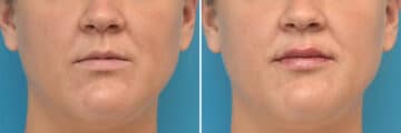 Injectable Fillers Before and After Photos in Philadelphia, PA, Patient 4483