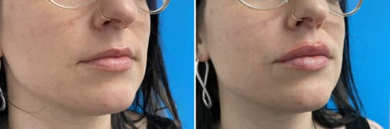 Injectable Fillers Before and After Photos in Philadelphia, PA, Patient 4484