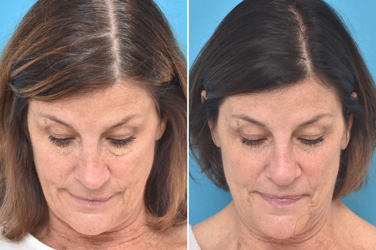 Rhinoplasty Before and After Photos in Philadelphia, PA, Patient 4521