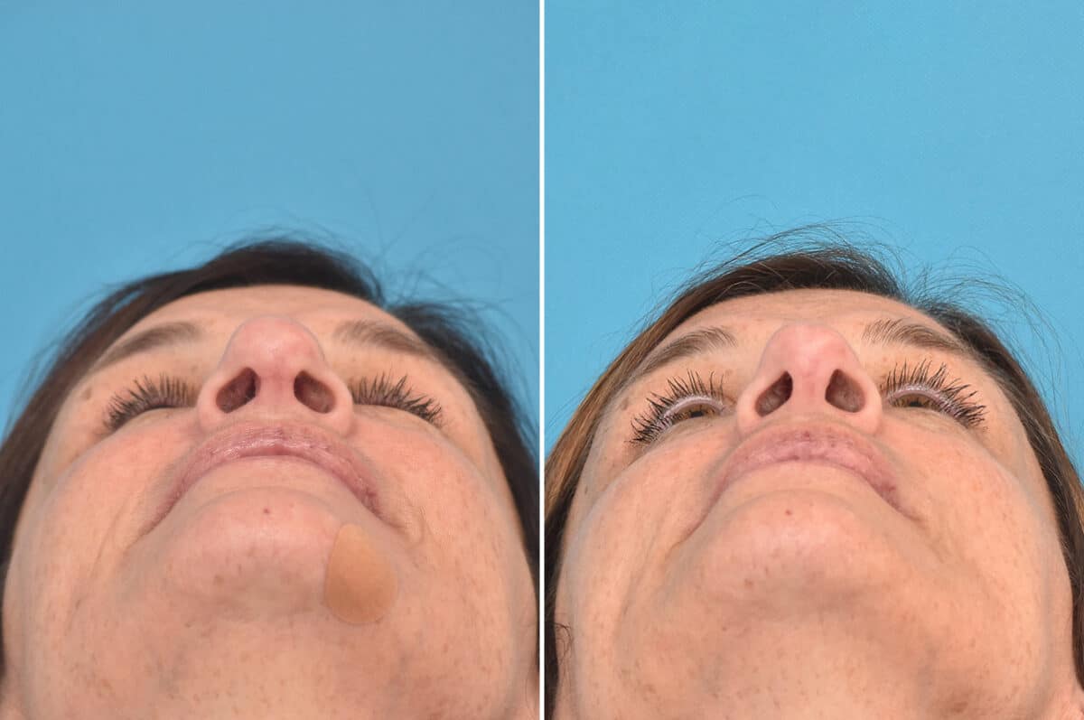 Rhinoplasty Before and After Photos in Philadelphia, PA, Patient 4521