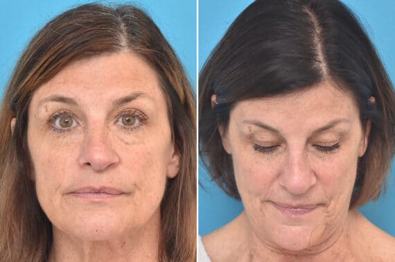 Rhinoplasty Before and After Photos in Philadelphia, PA, Patient 4521