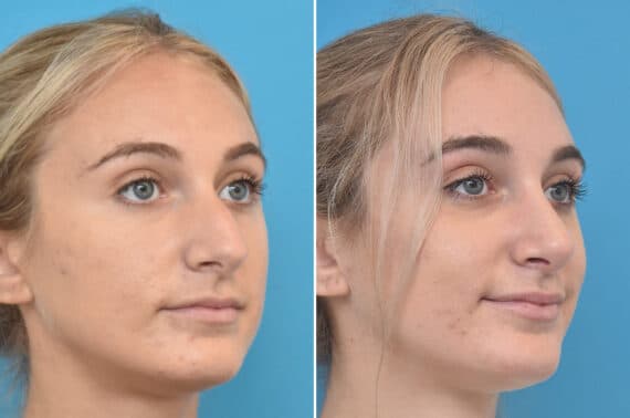 Rhinoplasty Before and After Photos in Philadelphia, PA, Patient 4522