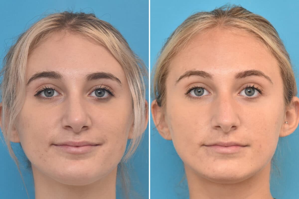 Rhinoplasty Before and After Photos in Philadelphia, PA, Patient 4522