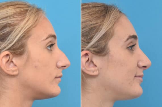 Rhinoplasty Before and After Photos in Philadelphia, PA, Patient 4522