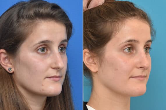 Rhinoplasty Before and After Photos in Philadelphia, PA, Patient 4523