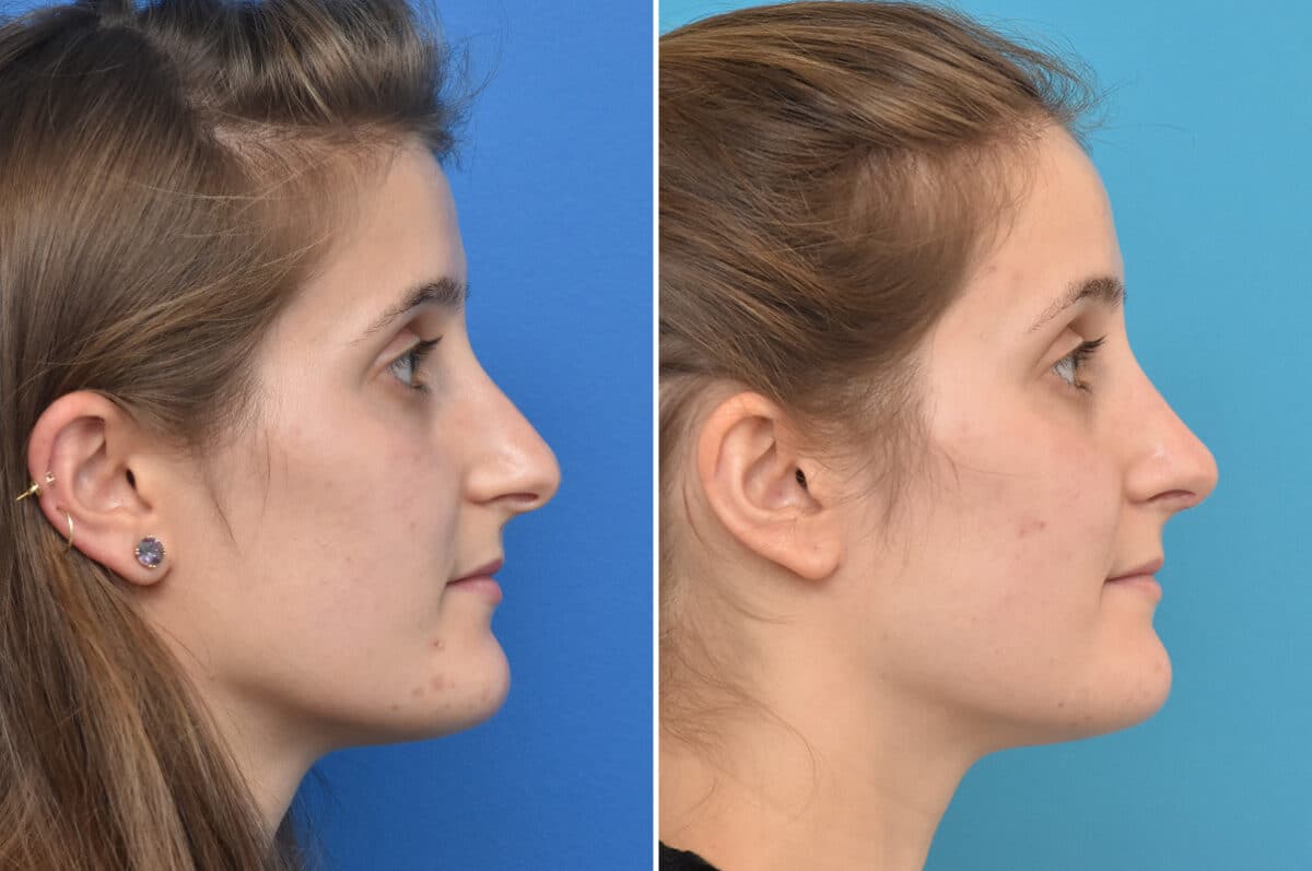 Rhinoplasty Before and After Photos in Philadelphia, PA, Patient 4523