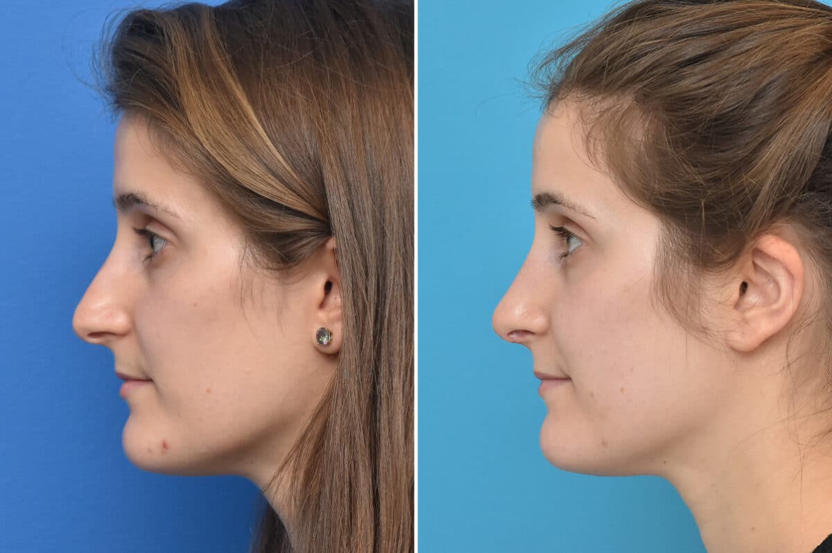 Rhinoplasty Before and After Photos in Philadelphia, PA, Patient 4523