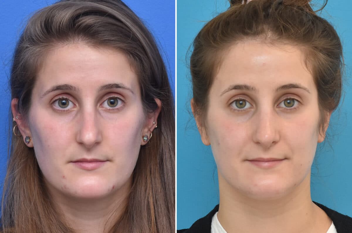 Rhinoplasty Before and After Photos in Philadelphia, PA, Patient 4523