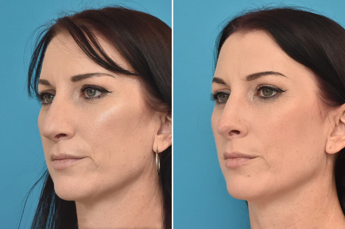 Rhinoplasty Before and After Photos in Philadelphia, PA, Patient 4524