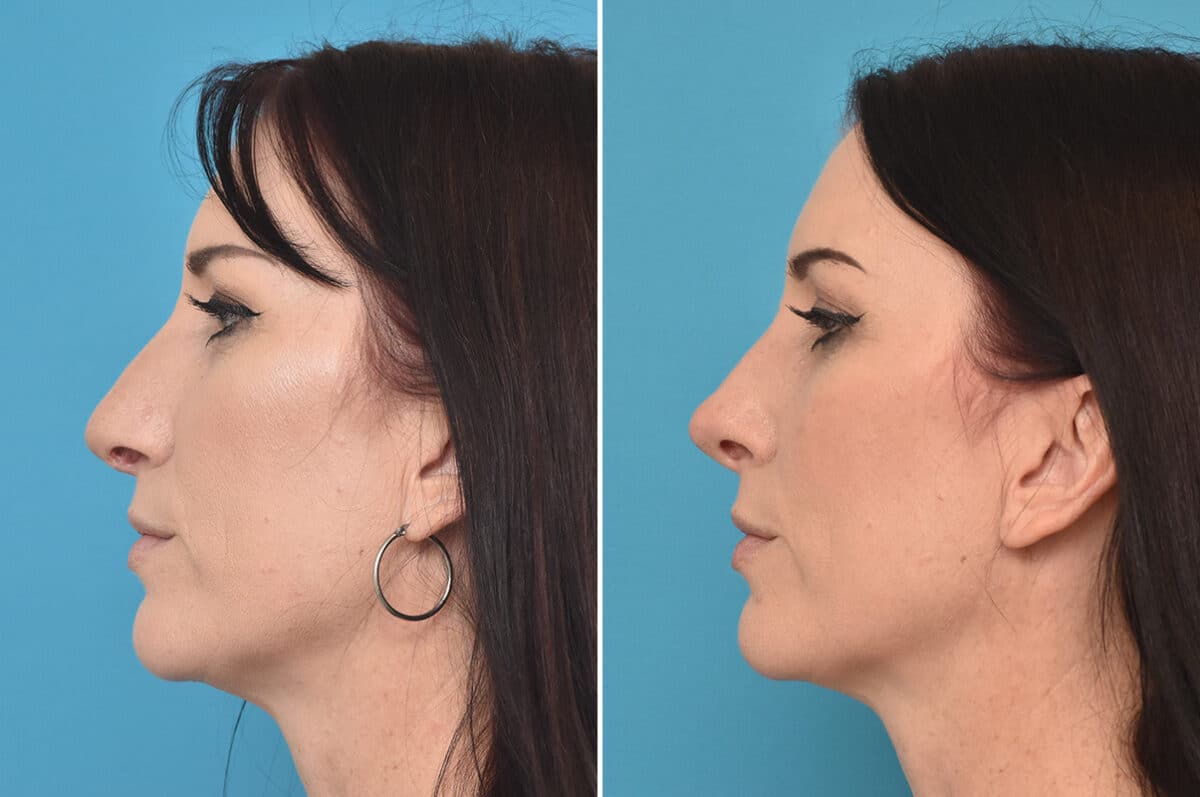 Rhinoplasty Before and After Photos in Philadelphia, PA, Patient 4524