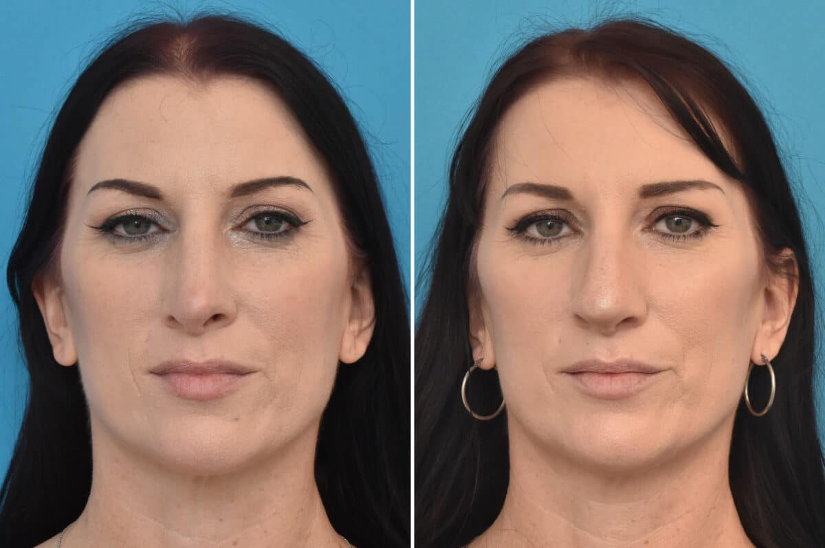 Rhinoplasty Before and After Photos in Philadelphia, PA, Patient 4524