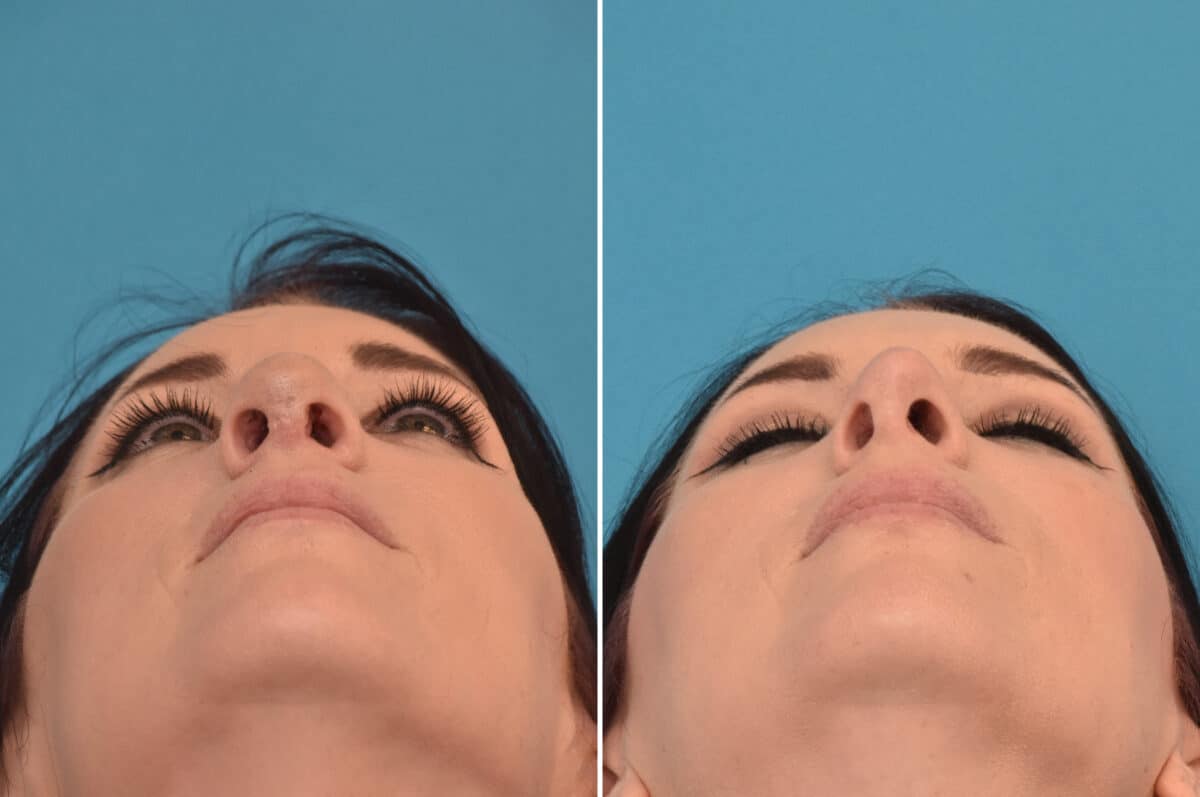 Rhinoplasty Before and After Photos in Philadelphia, PA, Patient 4524