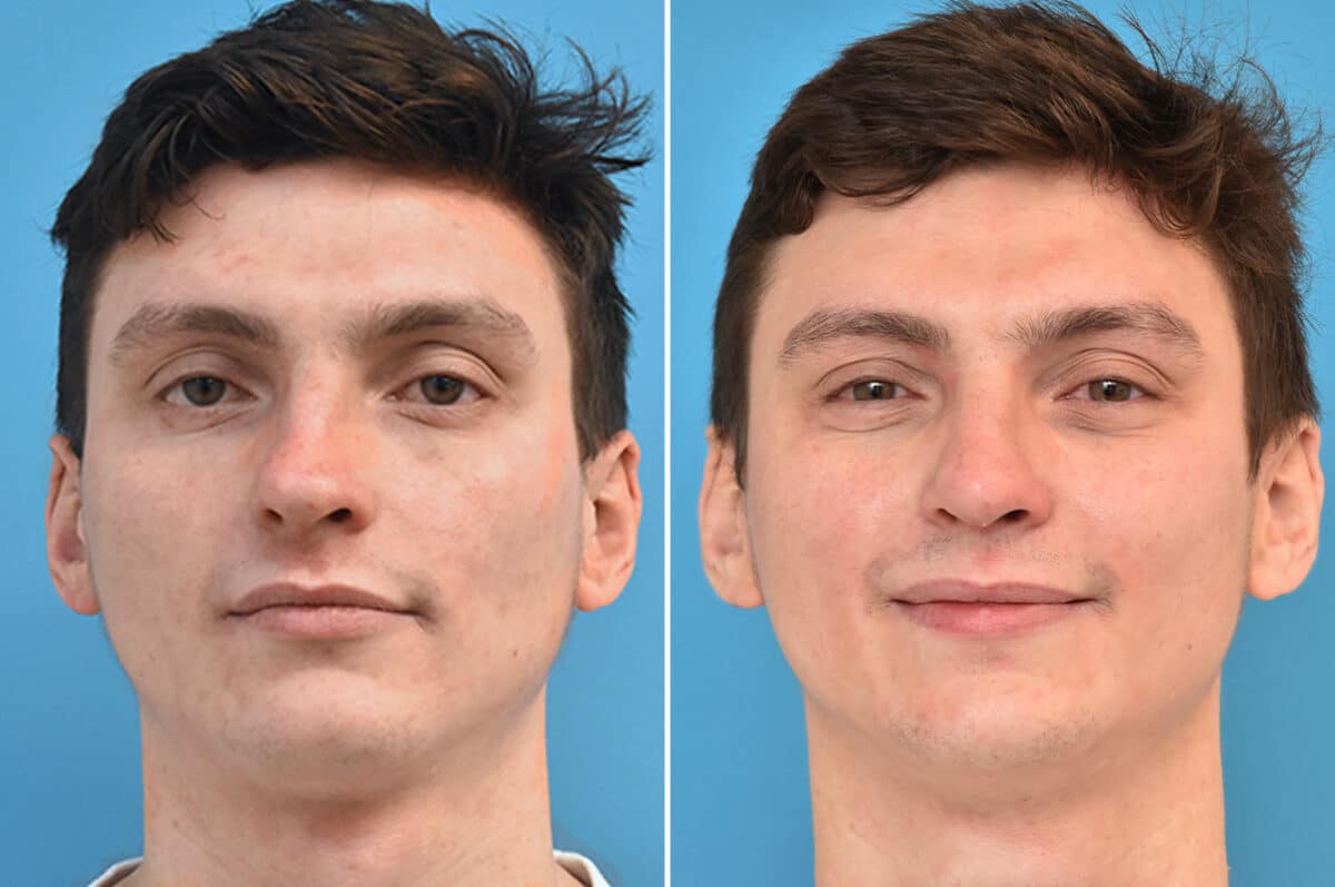 Rhinoplasty Before and After Photos in Philadelphia, PA, Patient 4569