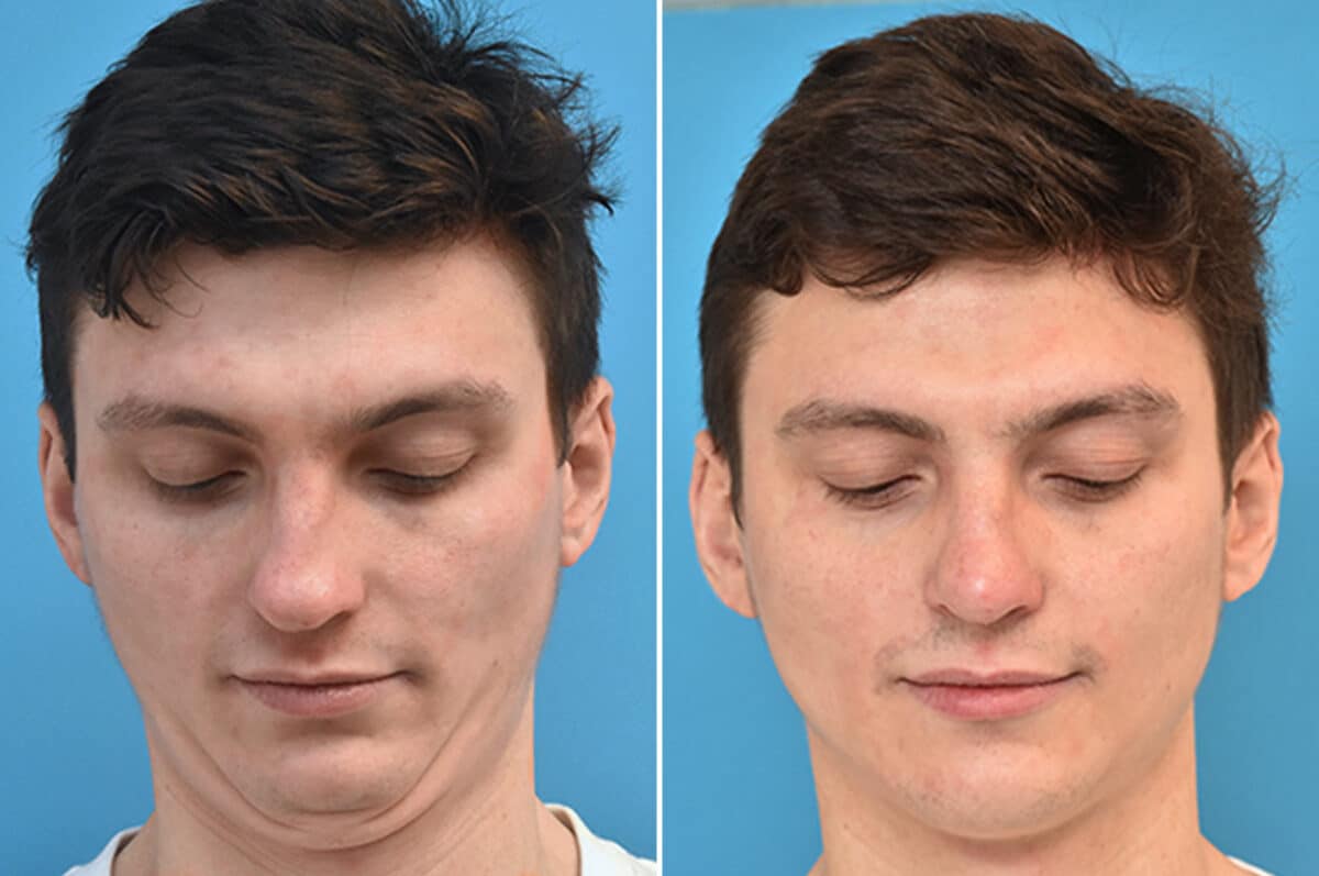 Rhinoplasty Before and After Photos in Philadelphia, PA, Patient 4569