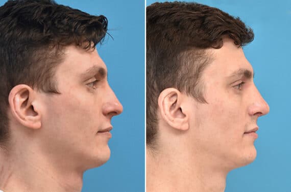 Rhinoplasty Before and After Photos in Philadelphia, PA, Patient 4569