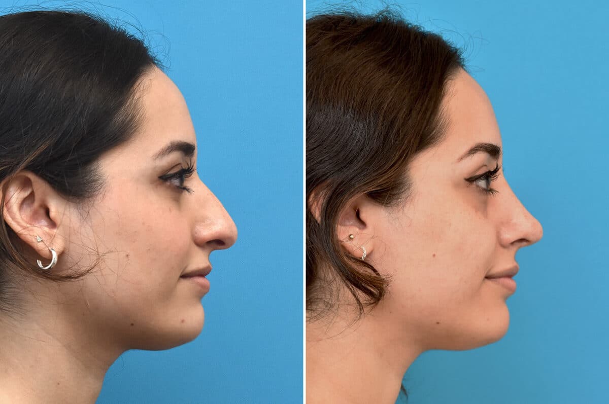 Rhinoplasty Before and After Photos in Philadelphia, PA, Patient 4570