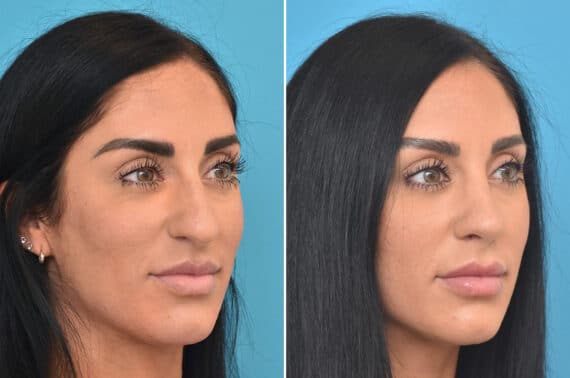 Rhinoplasty Before and After Photos in Philadelphia, PA, Patient 4571