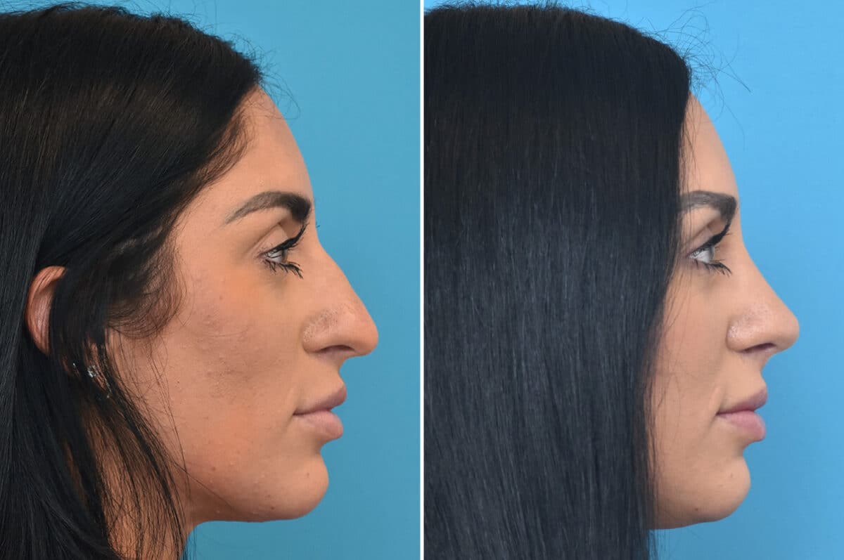 Rhinoplasty Before and After Photos in Philadelphia, PA, Patient 4571