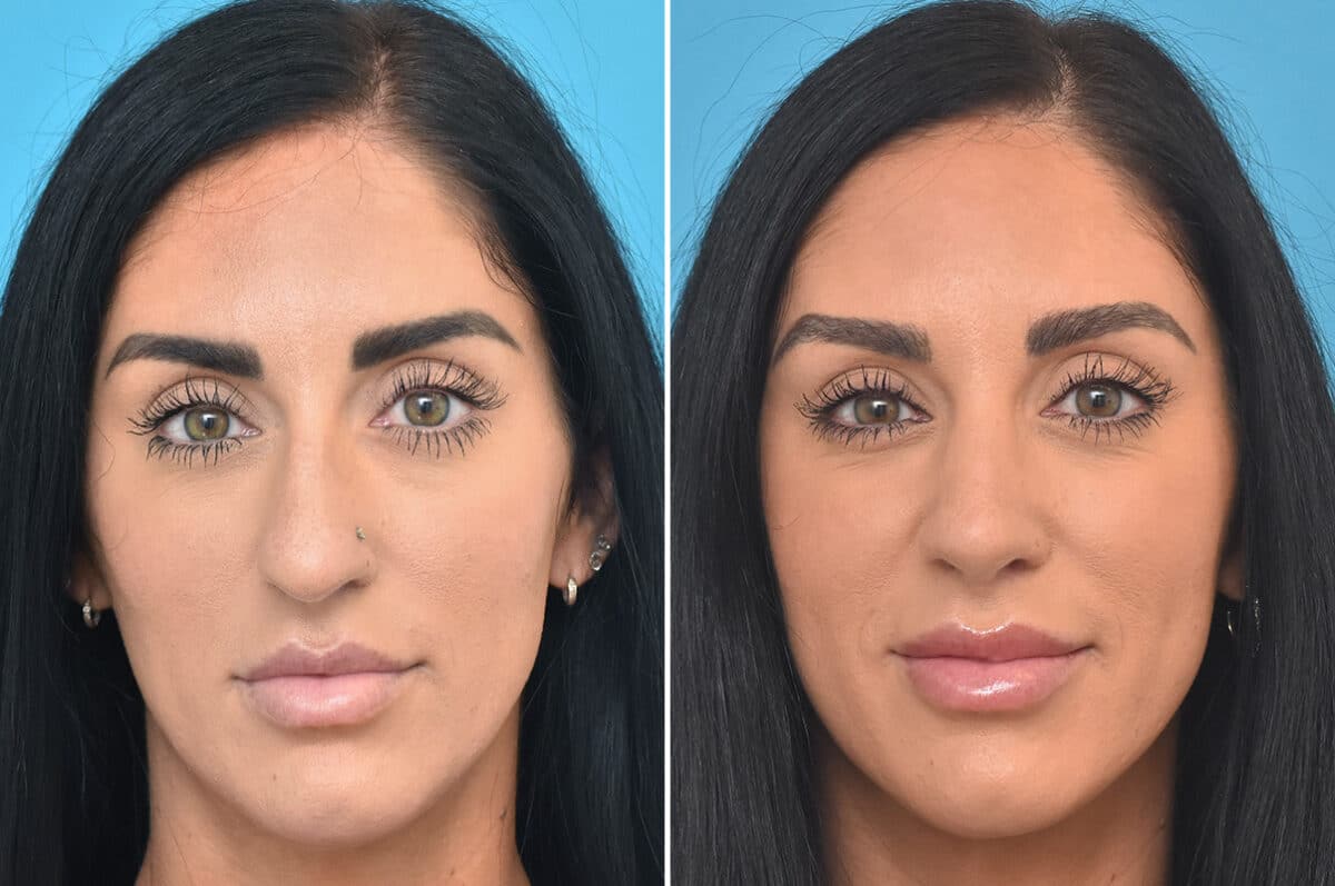 Rhinoplasty Before and After Photos in Philadelphia, PA, Patient 4571