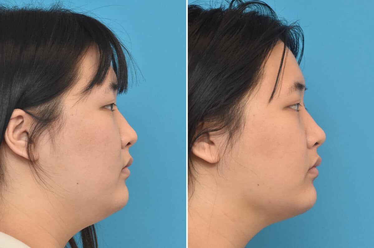 Rhinoplasty Before and After Photos in Philadelphia, PA, Patient 4572