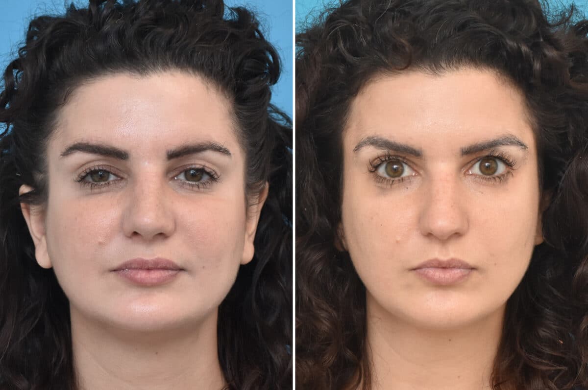 Rhinoplasty Before and After Photos in Philadelphia, PA, Patient 4589