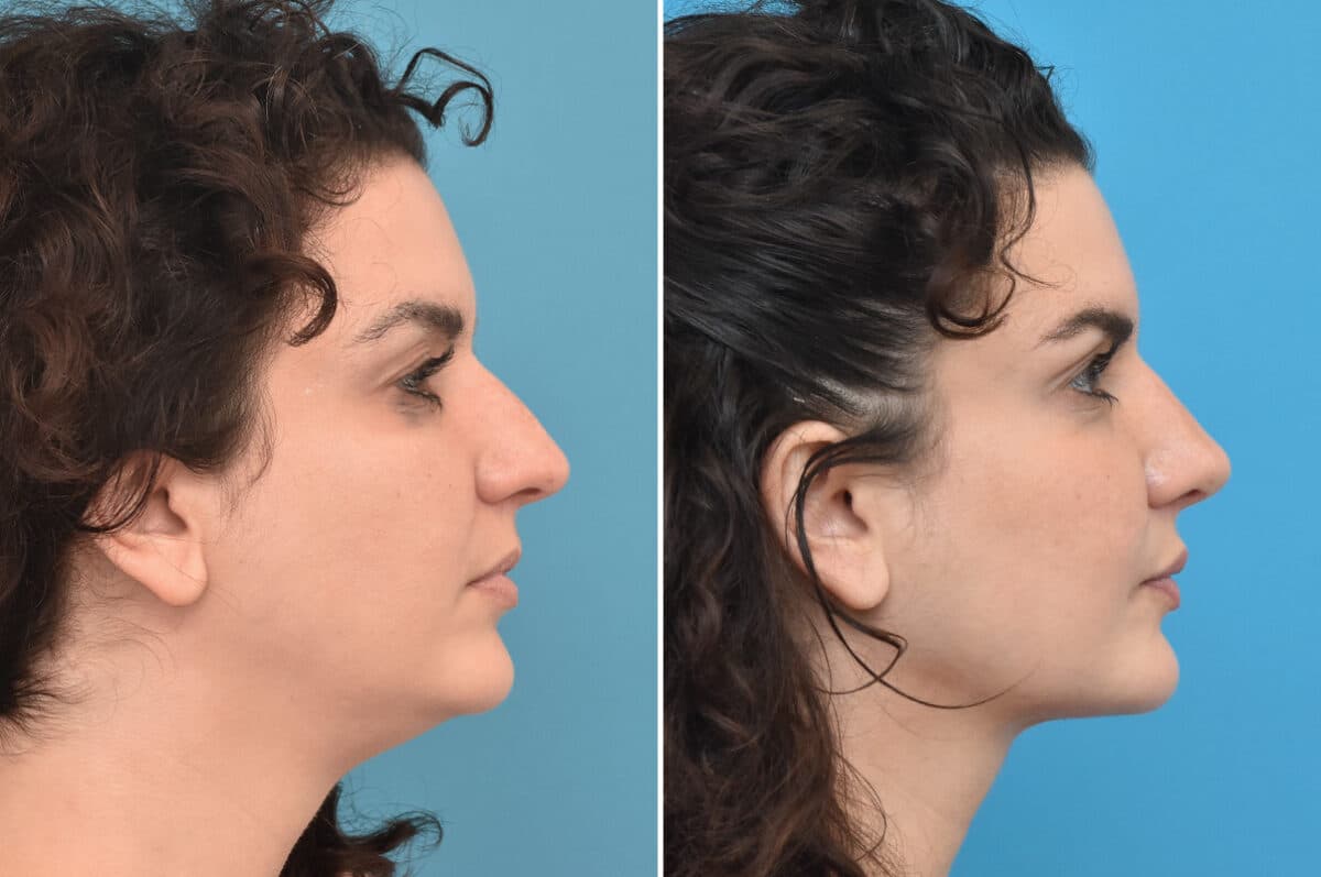 Rhinoplasty Before and After Photos in Philadelphia, PA, Patient 4589