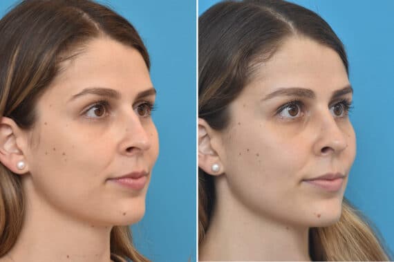 Rhinoplasty Before and After Photos in Philadelphia, PA, Patient 4594