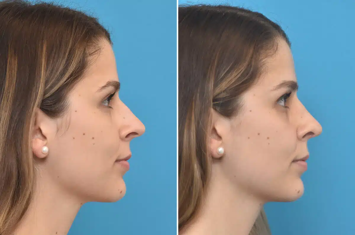 Rhinoplasty Before and After Photos in Philadelphia, PA, Patient 4594